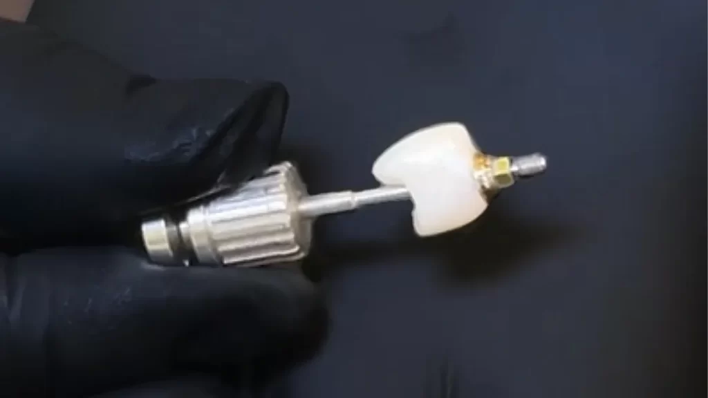 Precio de una corona dental en Perú