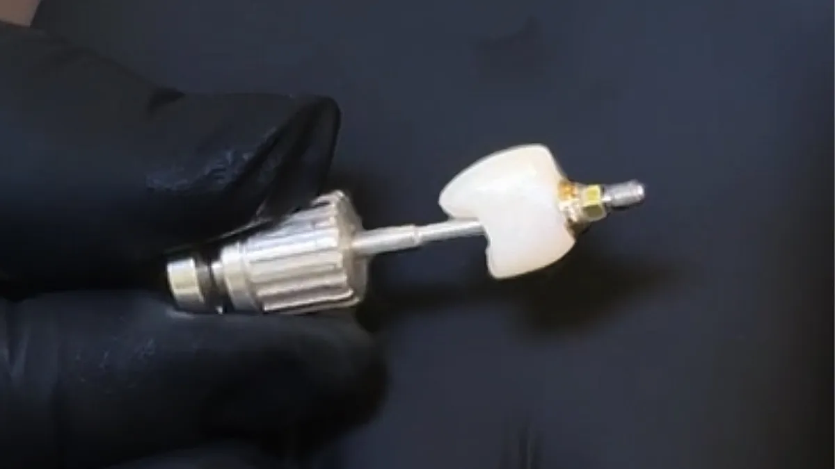 Precio de una corona dental en Perú