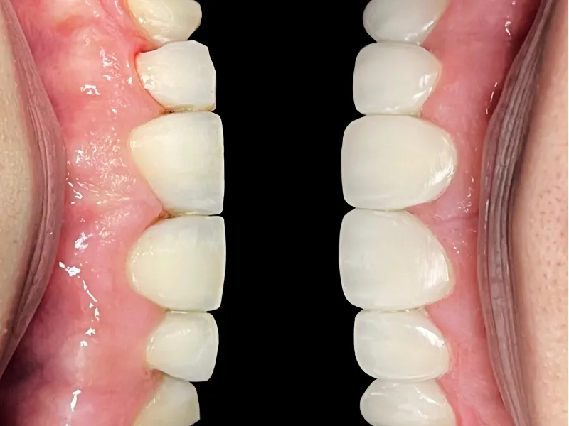 Qué son las carillas dentales y por qué elegirlas