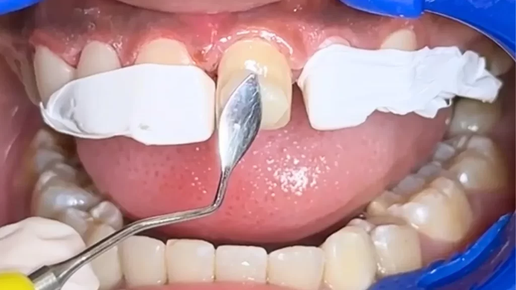 Precio de carillas dentales en Perú