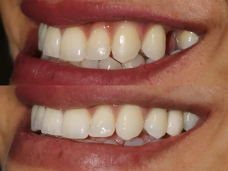 Qué factores influyen en el precio de una corona dental