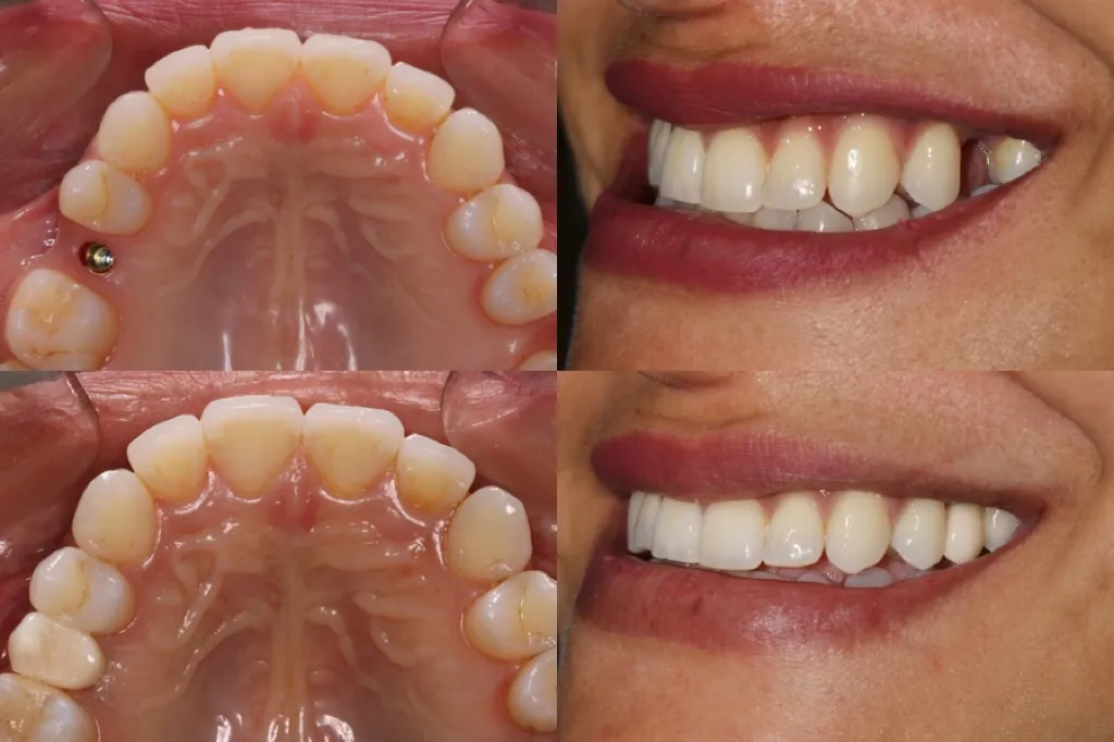 implante dental precio perú