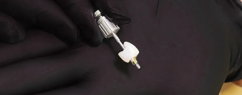 cost of dental implants