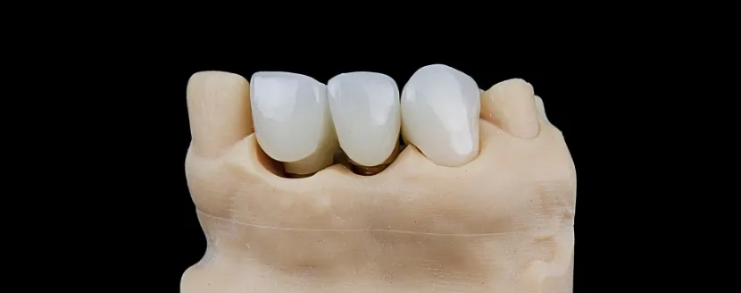 Precio puente dental