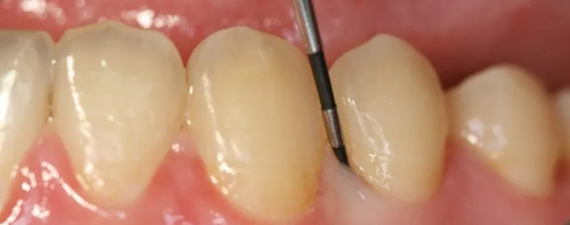 periodontal treatment costs