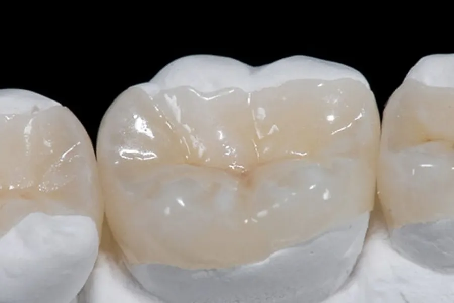 incrustación dental precio