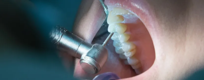 endodoncia precio perú