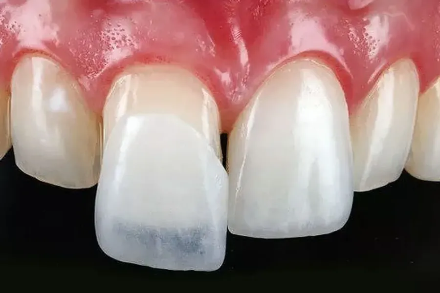 Smile Design with Veneers