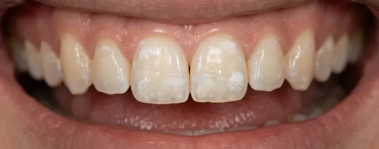 manchas-blancas-en-los-dientes
