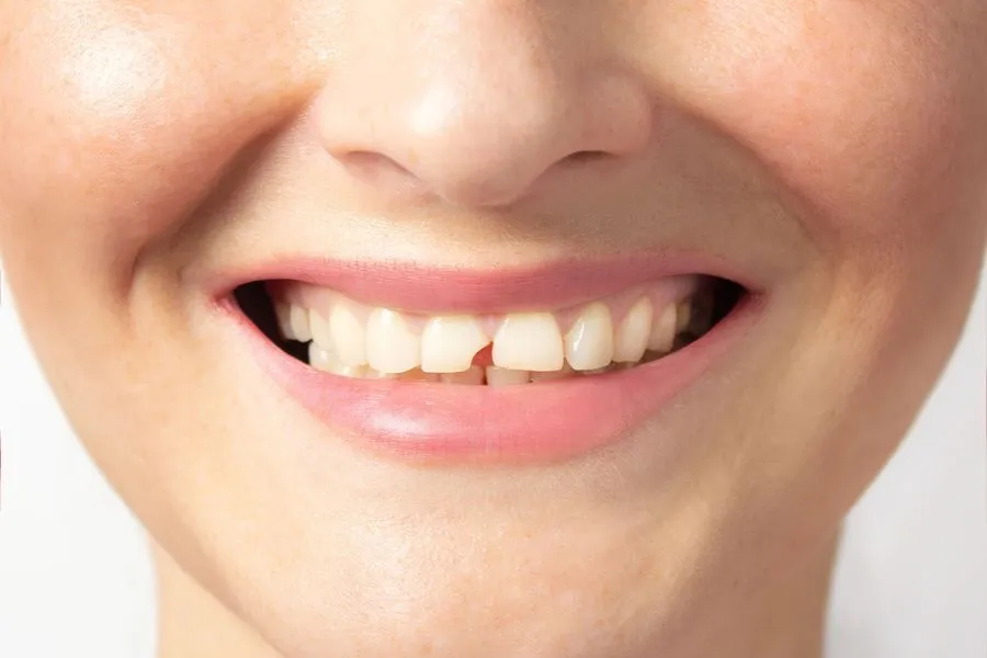 broken-tooth-repair-cost-peru