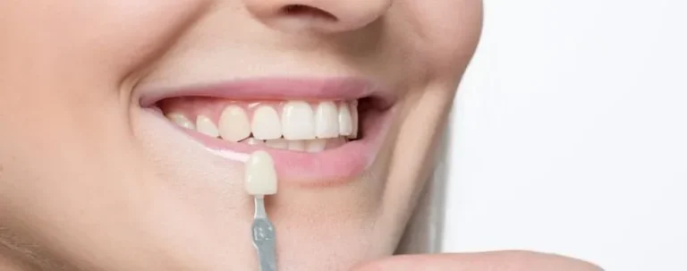 carillas-dentales-cuánto-duran