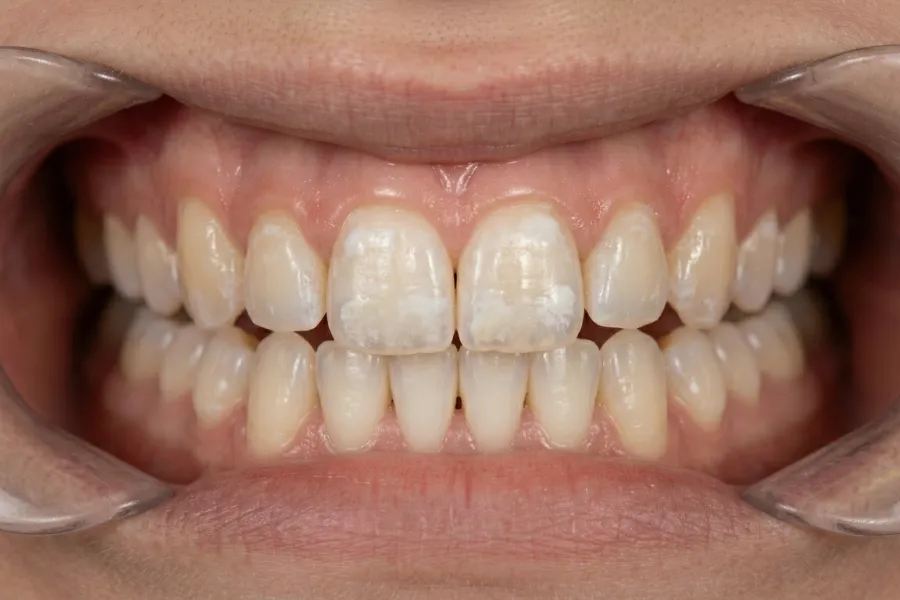 white spots on teeth