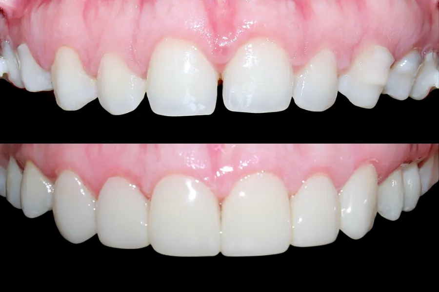 cuanto-cuesta-contorneado-dental