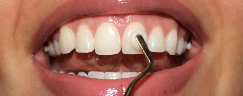 cuanto-cuesta-contorneado-dental