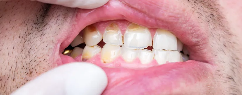 dientes-podridos-solución