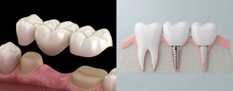 puente adhesivo dental