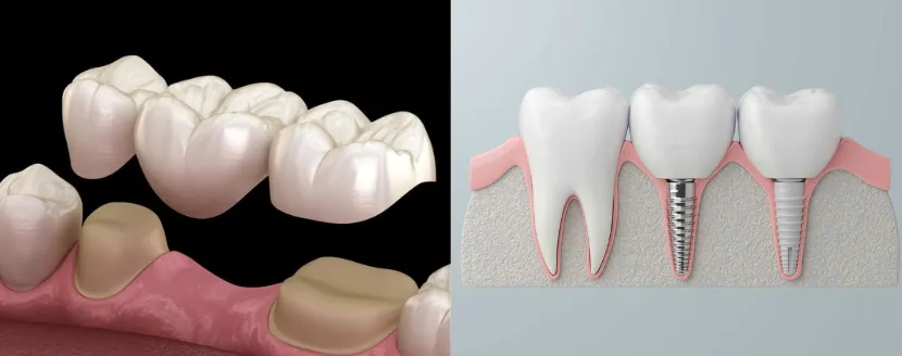 puente adhesivo dental