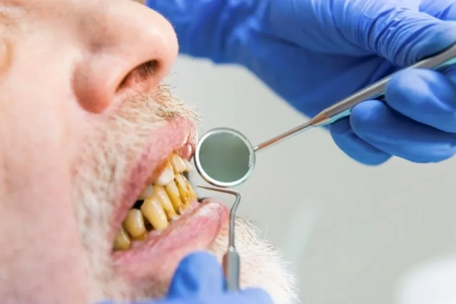 limpieza dental mal hecha