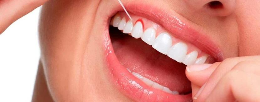 bleeding gums