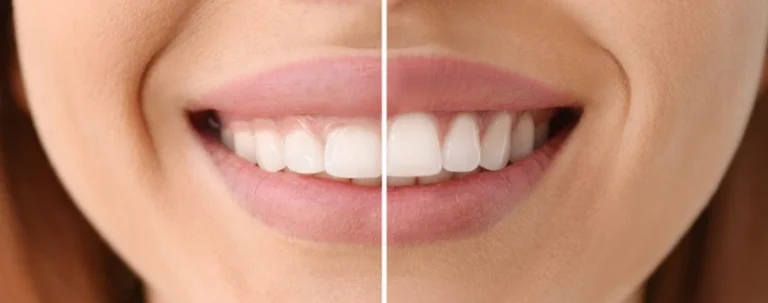 corregir sonrisa gingival