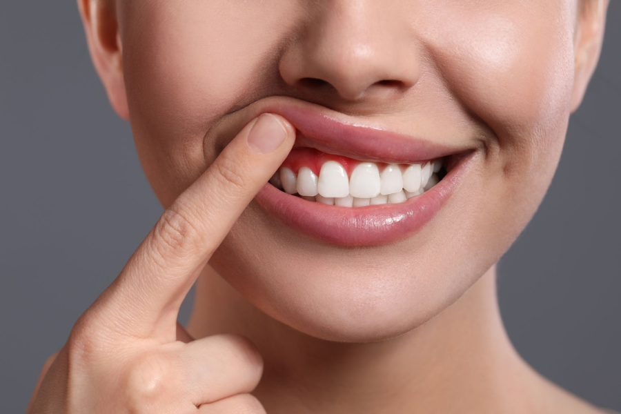 Can a gummy smile be corrected without surgery?