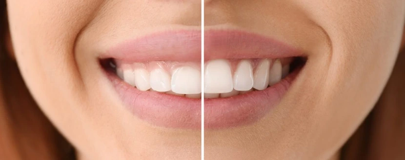 corregir sonrisa gingival